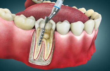 4D Root Canal Image